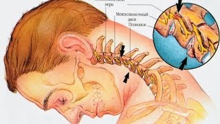 Грыжа шейного отдела позвоночника