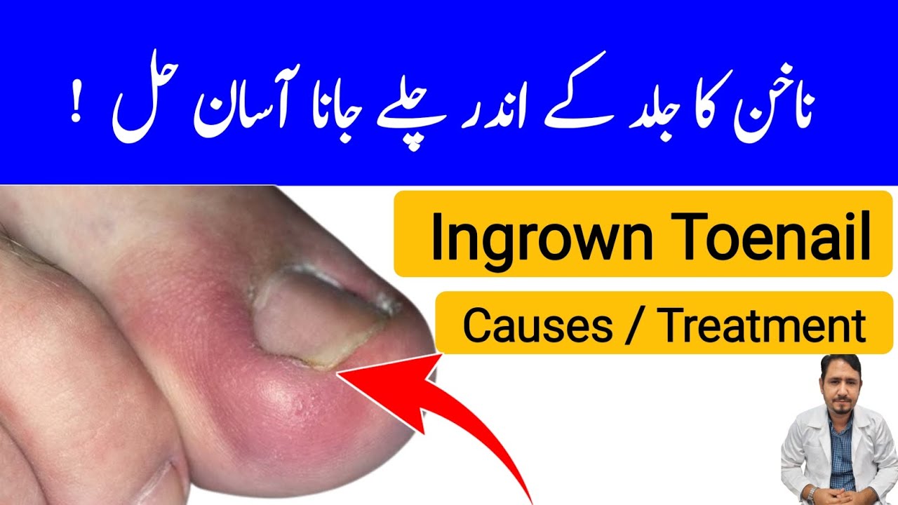 Ingrown Toenail Treatment In Urdu Hindi Irfan Azeem YouTube