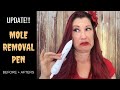 MOLE REMOVAL PEN BEFORE AND AFTER UPDATE // New Mole and Skin Tag Demos, Q & As