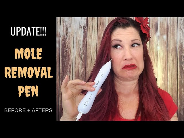 MOLE REMOVAL PEN BEFORE AND AFTER UPDATE // New Mole and Skin Tag Demos, Q  & As 