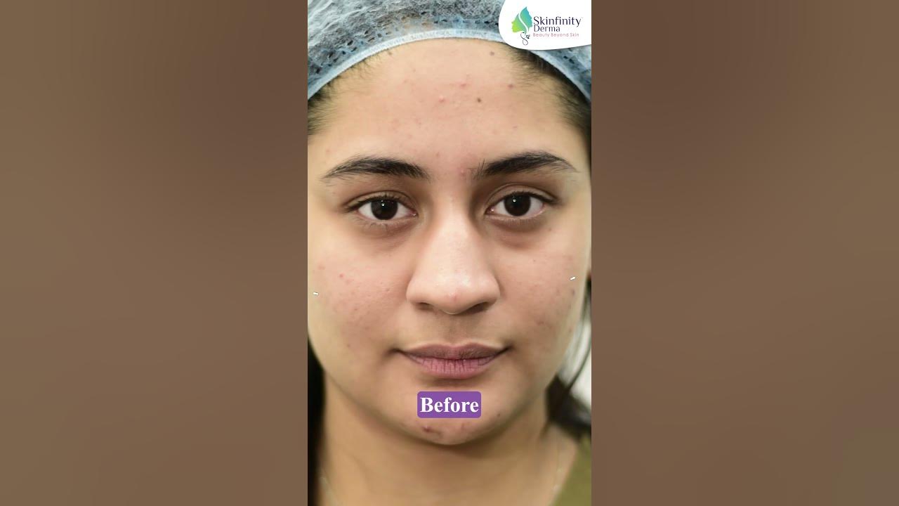 Before and After Dark Under Eye Treatment Using Hyaluronic Acid and