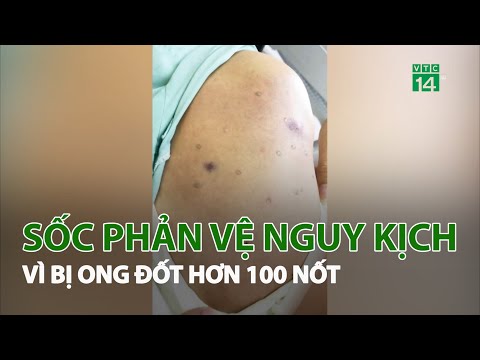 Video Sốc phản vệ nguy kịch vì bị ong đốt hơn 100 nốt | VTC14 - youtube