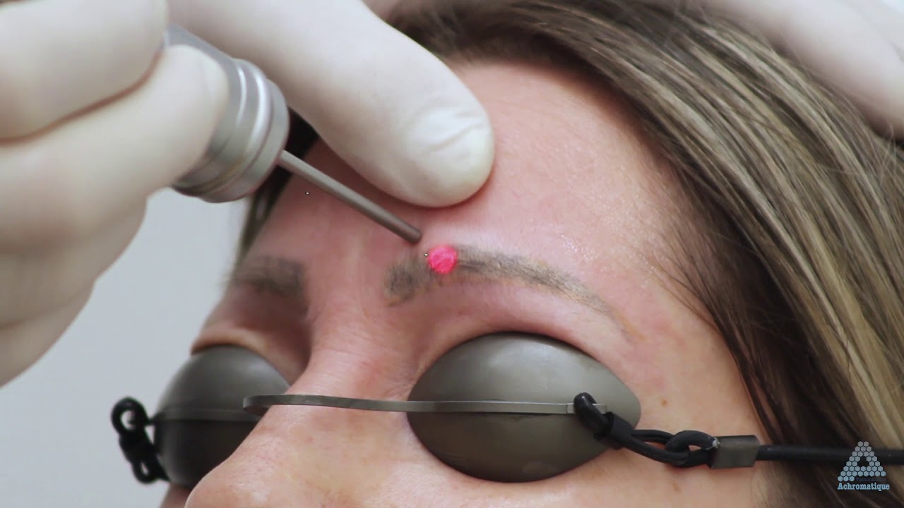 PicoStar Webinar mit Dr. Dr. Hans Bayer - Permanent Make-Up Entfernung