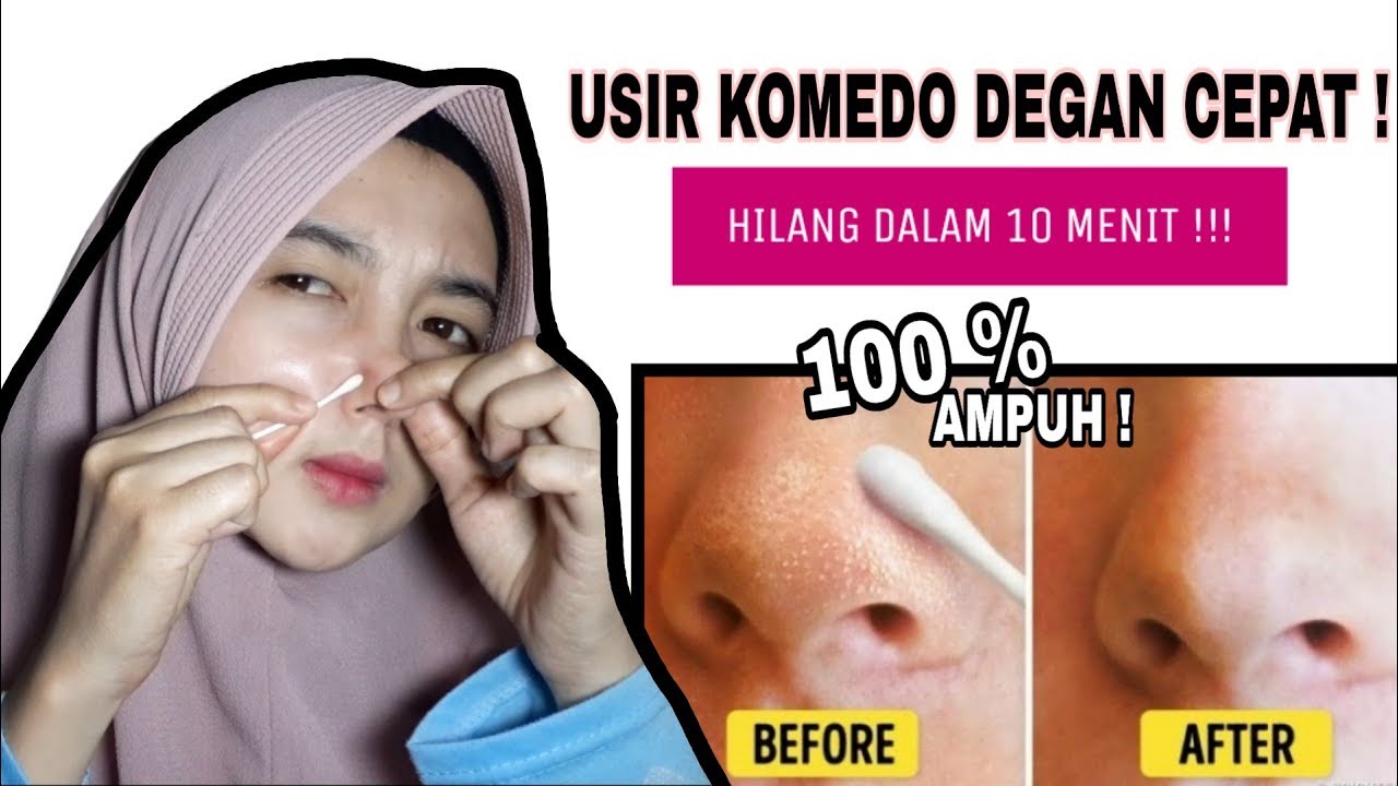 CARA MENGHILANGKAN KOMEDO DI HIDUNG | Cepat & Mudah - YouTube