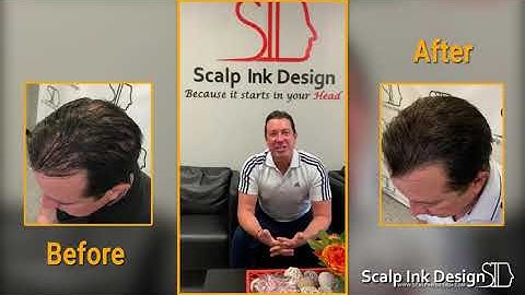 Scalp density with scalp micropigmentation. How to conceal thinning hair and balding with SMP?