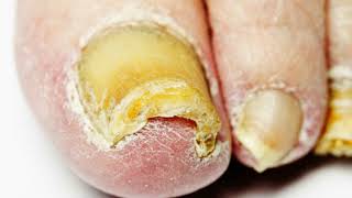 TOENAIL FUNGUS TREATMENT: How to Get Rid of Toenail Fungus Fast Naturally at Home