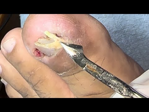 Ep_5938 Ingrown toenail removal 👣 คลิปหลัง ๆ ทำไมสั้นครับ  😁 (clip from Thailand)