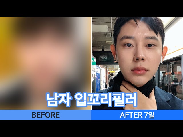 입꼬리올리기 궁금증 다 풀어드림(feat.남자입꼬리필러)