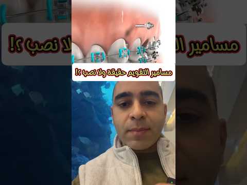 هل دعامات مسامير زريعات التقويم مفيدة ولا دفع فلوس على الفاضي    