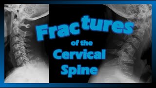 Fractures of the Cervical Spine #fracture #trauma #cervical
