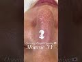 【毛穴エクストラクション】モンローションで自宅ケアしてるとエステは1分くらい