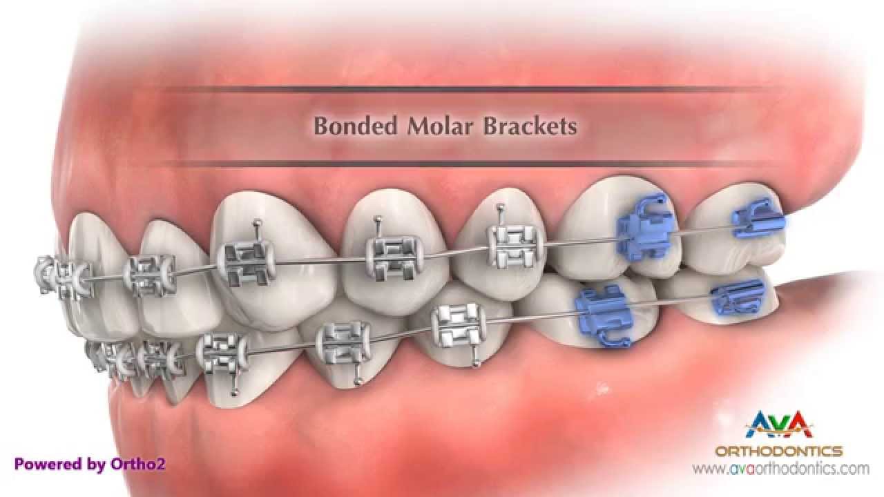 Parts of Braces Part 1 - Orthodontic Treatment - YouTube