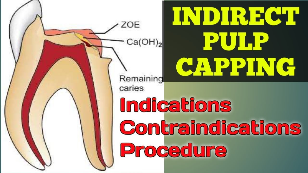 Indirect Pulp Capping IPC Indications Contraindications And indirect-pulp-capping-ipc-indications-contraindications-and