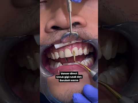 Video: Dapatkah luminer memanjangkan gigi?