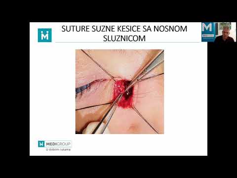 MediGroup webinar, dr Zoran Žikić - Hirurško rešavanje stečene neprohodnosti suznih puteva