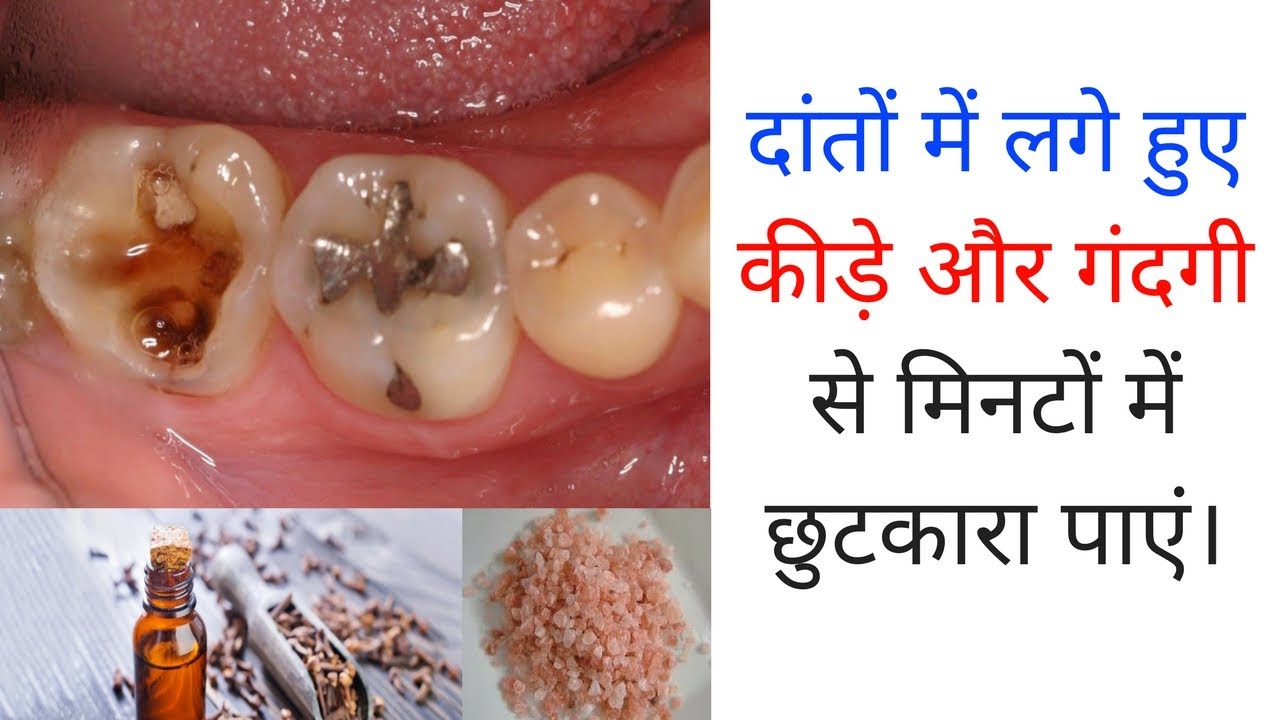 How To Remove Tartar From Teeth Without Dentist In Hindi