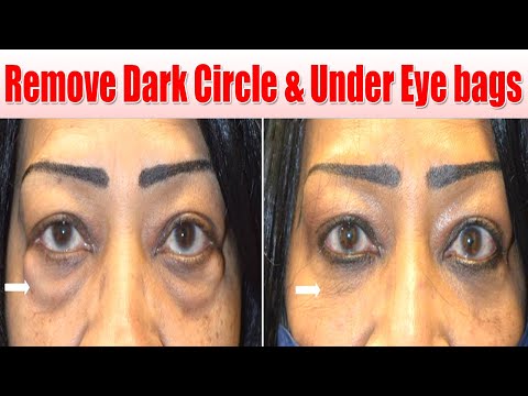 i Removed DARK CIRCLES in 5 Days with Aloevera Gel! Remove Dark Circle &amp; Under Eye bags