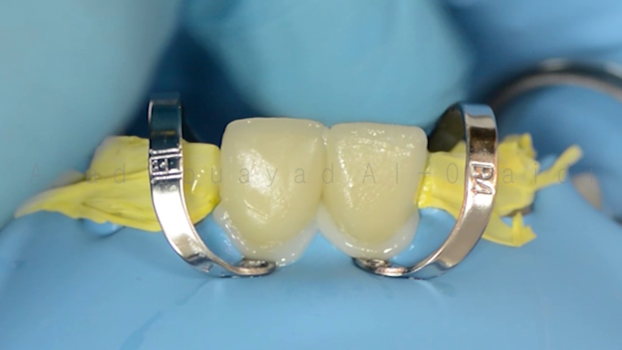 Laminate Veneer cementation - YouTube