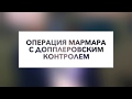 Операция Мармара при варикоцеле c допплеровским контролем