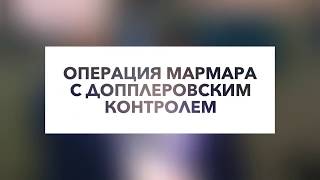 Операция Мармара при варикоцеле c допплеровским контролем