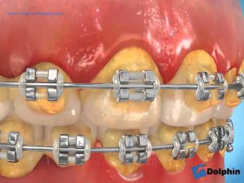 Perdida de peso brackets