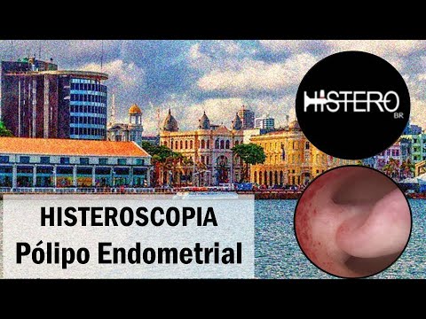 Histeroscopia Cirúrgica para Polipectomia - Pólipo Endometrial