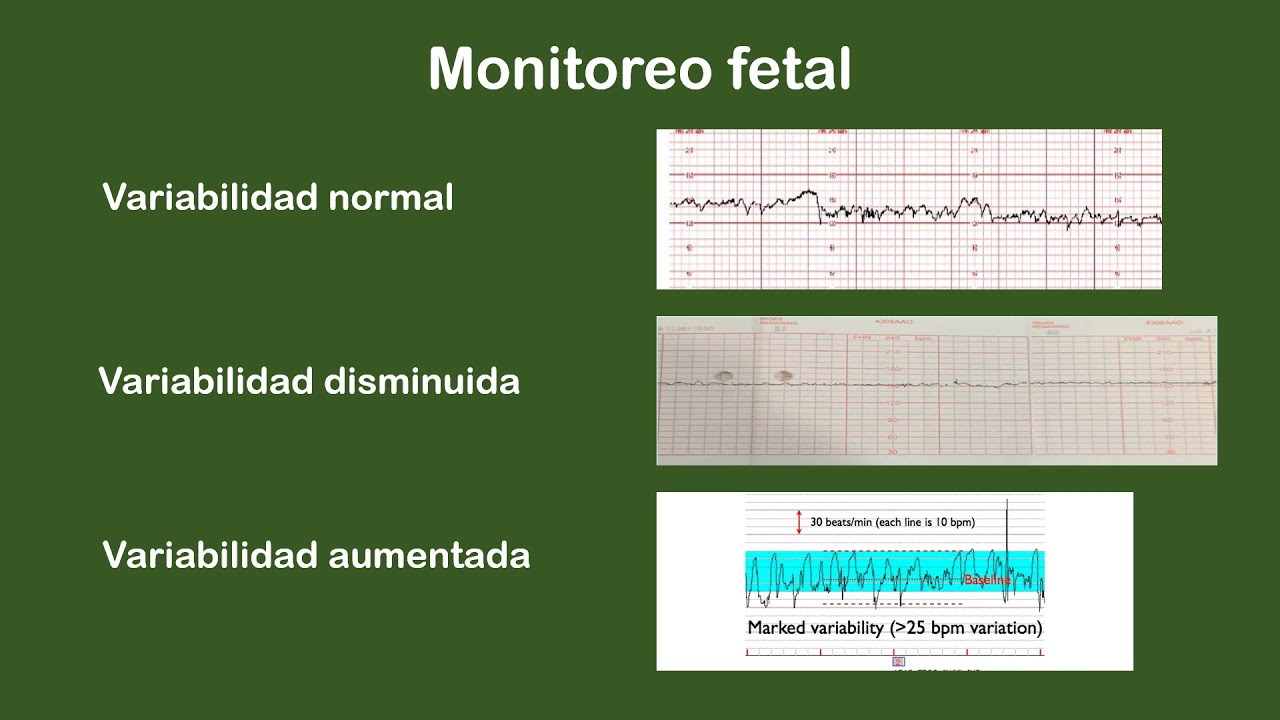Monitoreo fetal - MEDIAVILLA - Obstetricia - Fundación H. A. Barceló