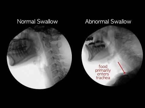 Normal vs Abnormal swallowing