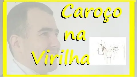 O que pode ser um caroço na virilha?