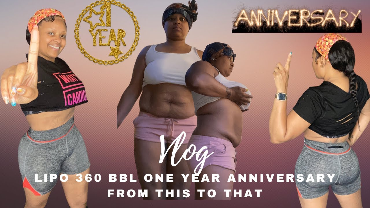 LIPO 360 BBL ONE YEAR POST OP *A WASTE *DR *DON'T GET CAUGHT UP *BODY ...