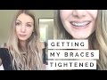 Getting My Braces Tightened For The First Time! | 1 MONTH UPDATE