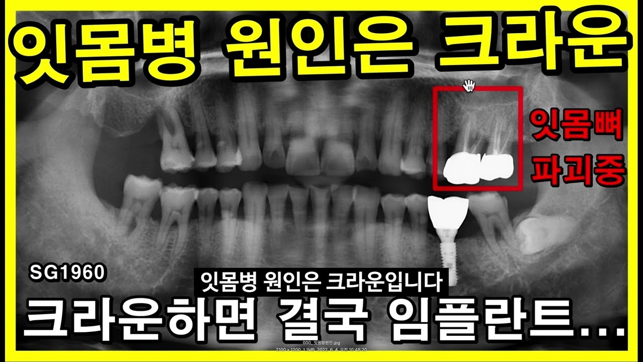치은염의 고름에 대처하는 방법 8