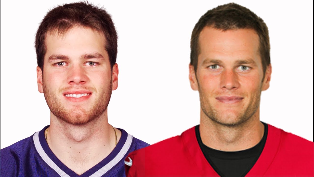 tom brady hair transplant before after