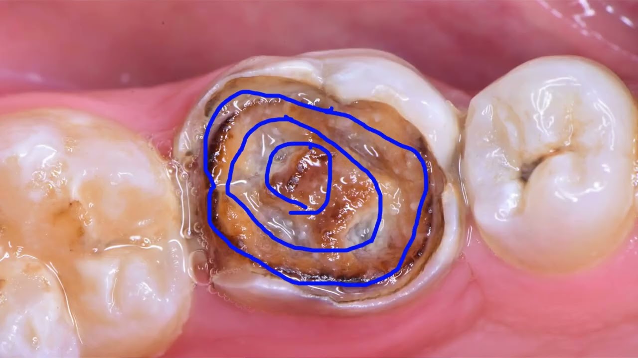 Biomimetic - Caries Removal End-Point | مدرسة البايوممتك - ازالة التسوس