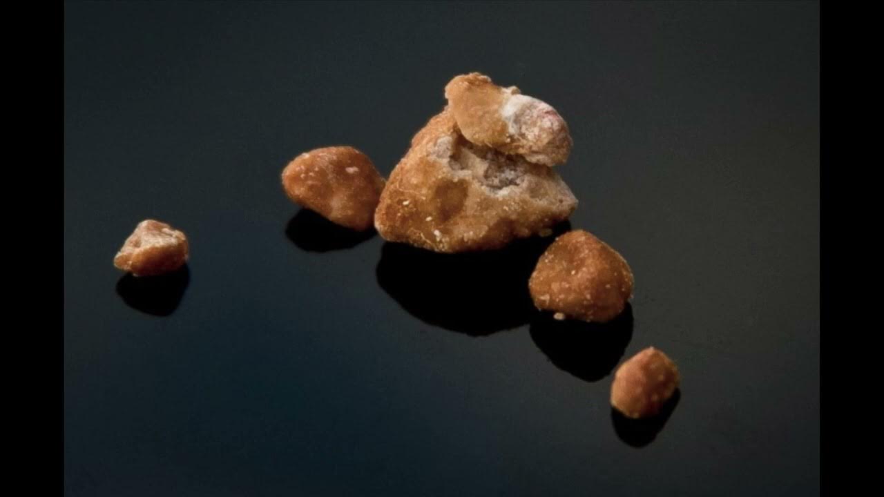 Как появляются камни в почках
