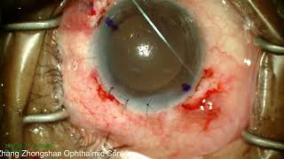 107. ICCE+Anterior vitrectomy+Scleral fixation of IOL