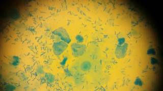 Трихомонада - Мазок Из Вагины Trichomonas - Smear From The