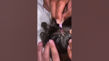 What REALLY Happens When You Pull a Worm Out of Your Scalp