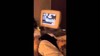 1st ultrasound - heartbeat