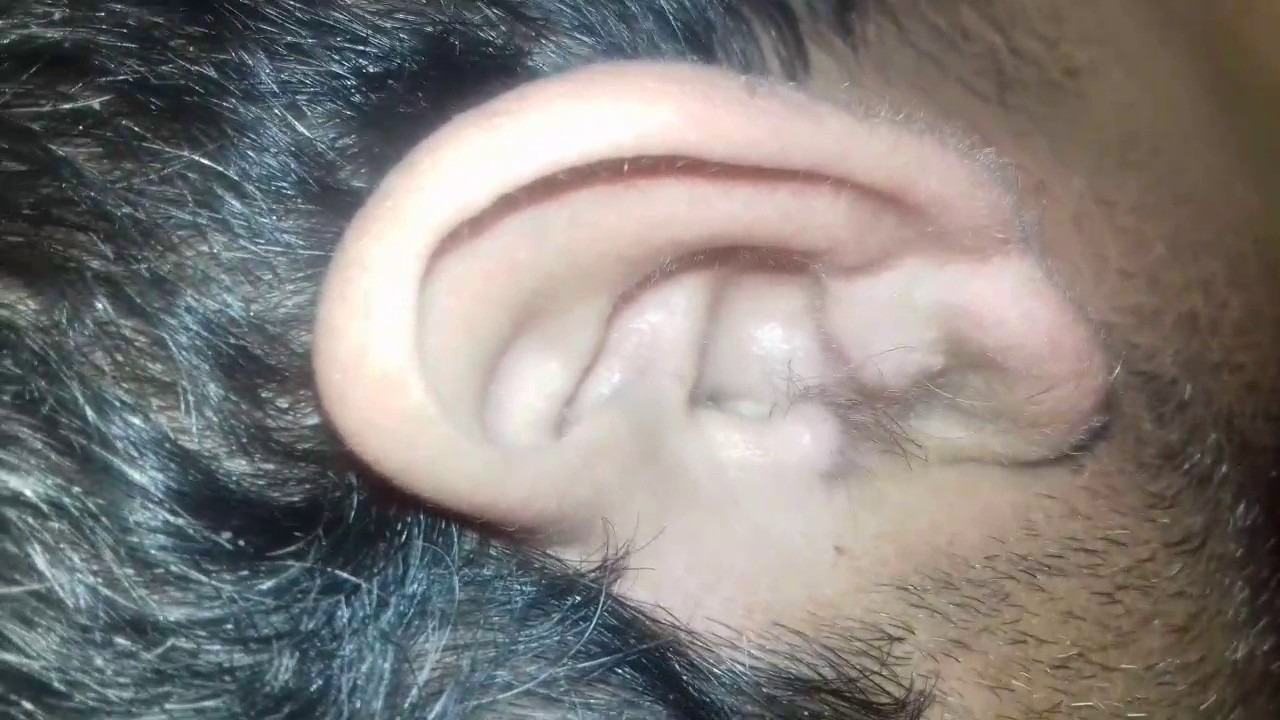 agua oxigenada tapon cera
