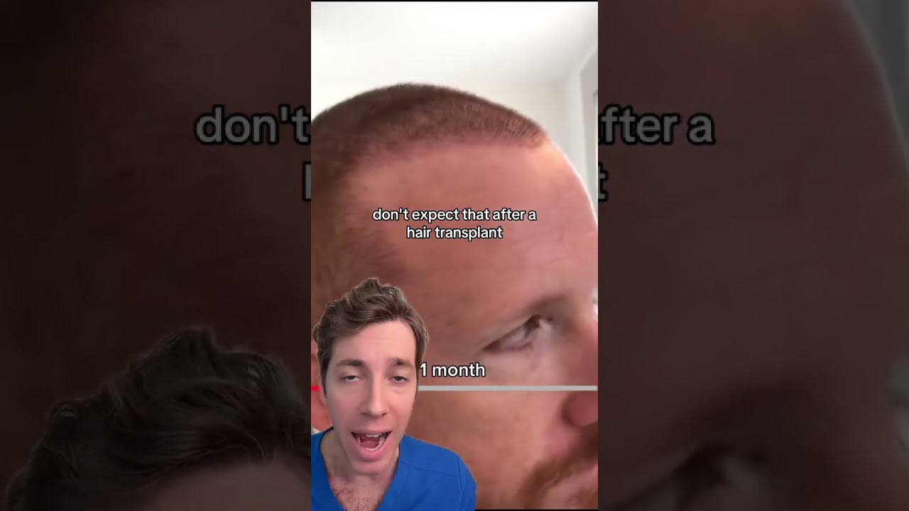 The Hair Transplant Timeline What To Expect
