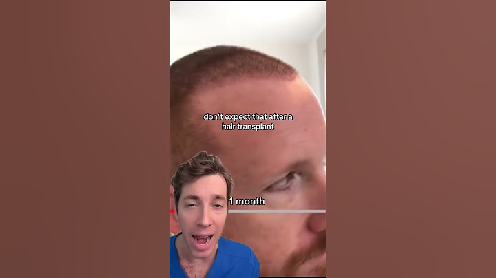 The Hair Transplant Timeline: What to Expect