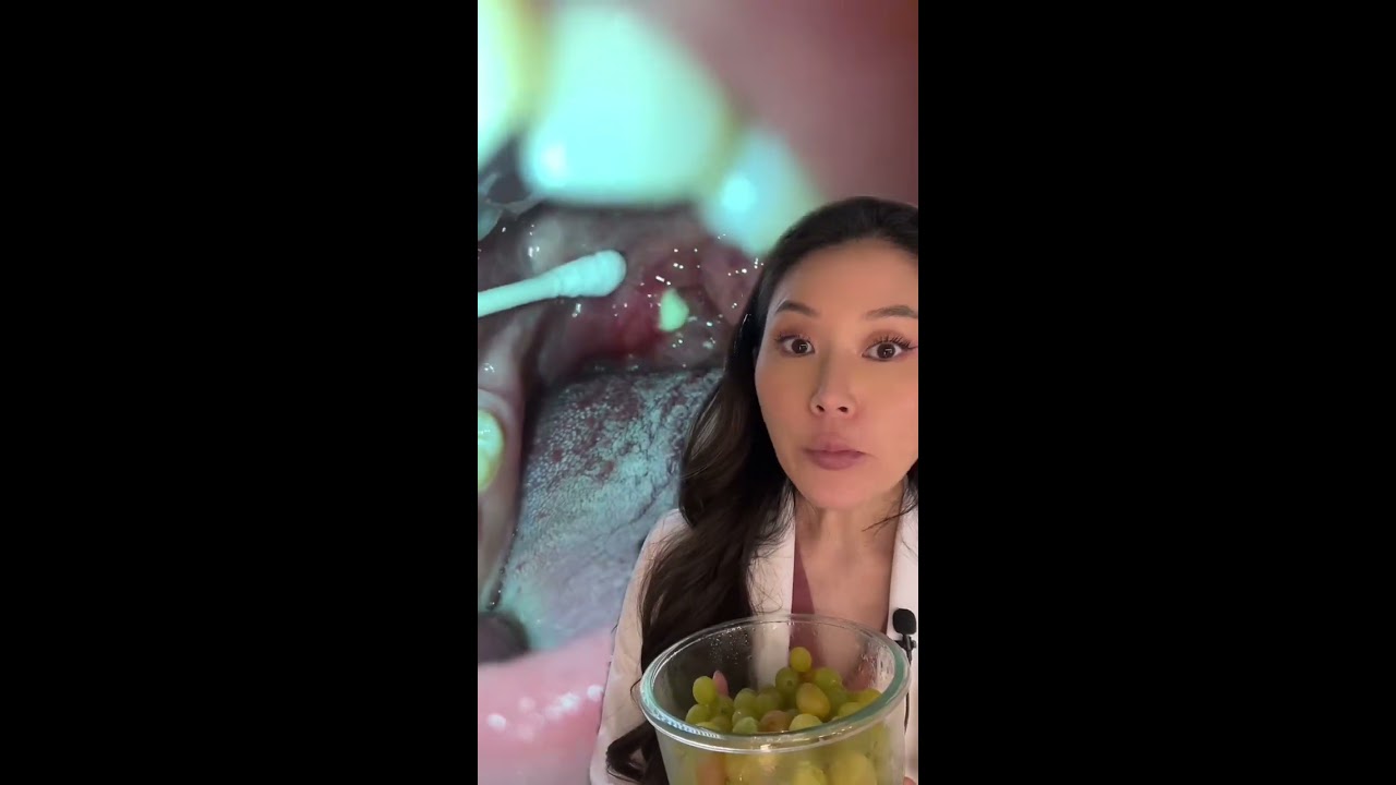 WHOA MEGA Tonsil Stone Extracted With A Qtip Dentist Tonsilstones