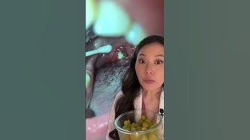 うわあ！綿棒で巨大な扁桃石を摘出しました #歯医者 #扁桃石