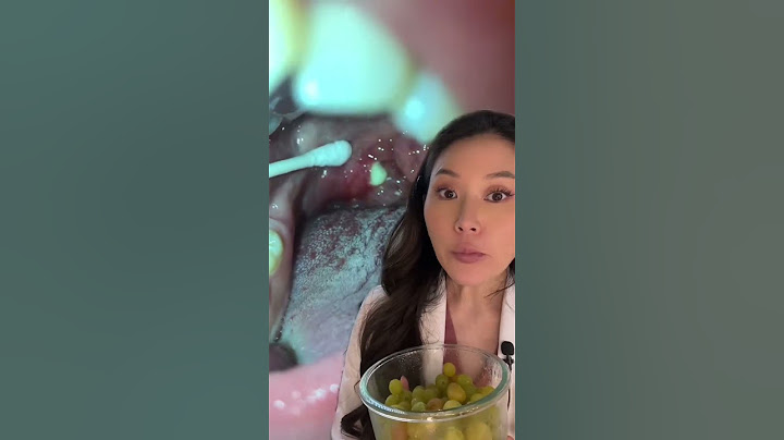 WHOA! MEGA Tonsil Stone extracted with a Qtip #dentist #tonsilstones