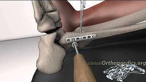 Operative treatment of ankle fractures
