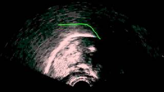 B alveolar implosive