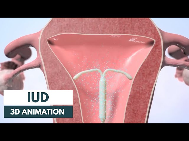 How does an IUD work? | 3D animation class=