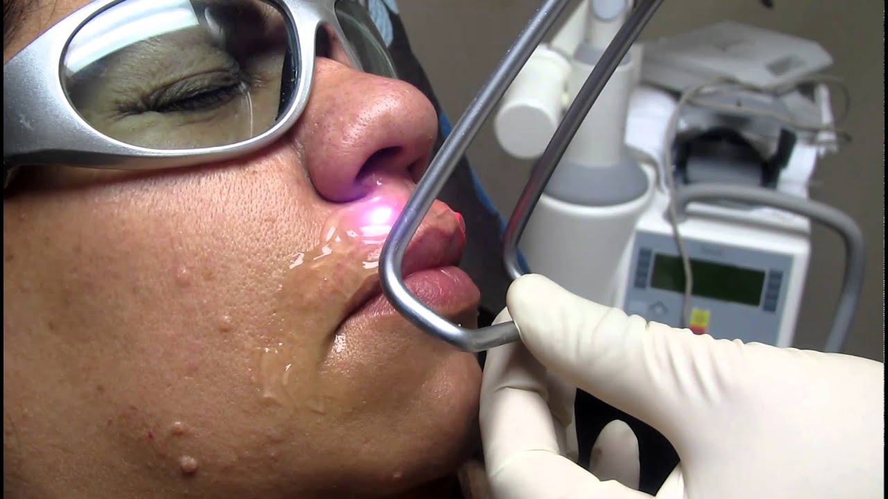 Laser Hair Removal In Whittier,Rowland Heights,Diamond Bar,Chino Hills,West Covina and Covina