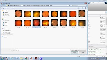 ANN Detection Using ANN - Glaucoma Detection Using Artificial Neural Network